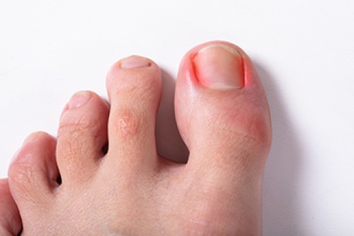 Ingrown Toenail Care